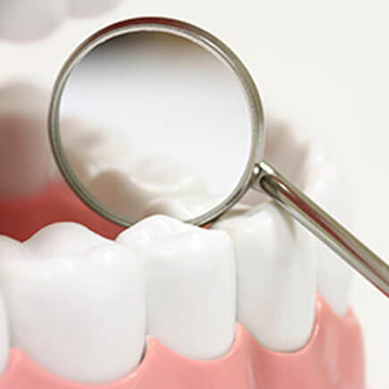 img-Dental-Sealants