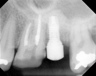 15 Sinus Lift, Bone Graft, Implant 4-5x10mm 3i-after-1