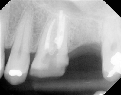 15 Sinus Lift, Bone Graft, Implant 4-5x10mm 3i-before-1