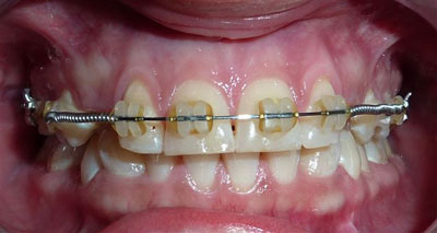 Canine Exposure for Orthodontic Treatment-before-1