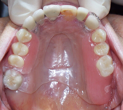 Case 7-Clear Frame Maxillary Partial-after-1