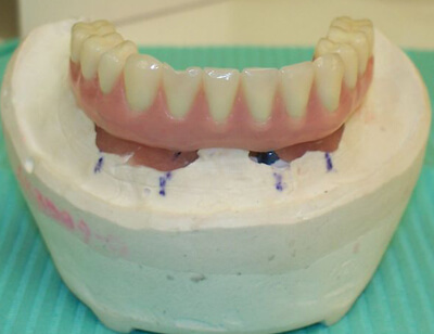 Fixed Implant Retained Denture-Hybrid Denture-after-1