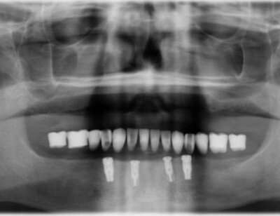 Fixed Implant Retained Denture-Hybrid Denture-before-1