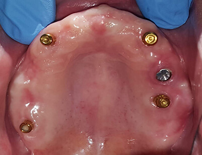 Four Implants with Locators supporting Upper-after-1