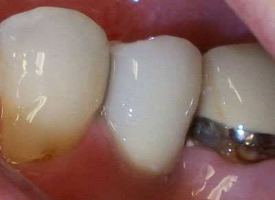 Immediate Implant-Zirconia Abutment and Crown-20-after-1