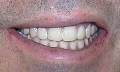 Immediate Maxillary Complete Denture-after-1