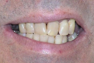 Immediate Maxillary Complete Denture-before-1