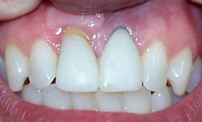 Implant-Supported-Crown-before-1
