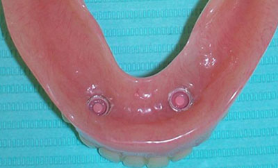 Implant-Supported-Mandibular-Denture-with-Locators-after-1