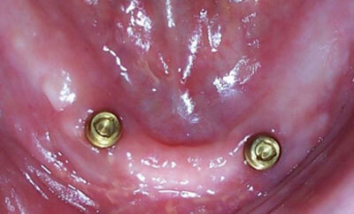 Implant-Supported-Mandibular-Denture-with-Locators-before-1