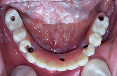 Mandibular Hybrid Denture supported by 5 Implants-after-1