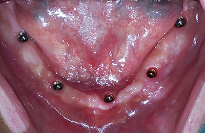 Mandibular Hybrid Denture supported by 5 Implants-before-1