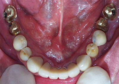 Mandibular bridge-22-27-Implants-18-19-30-31-before-1