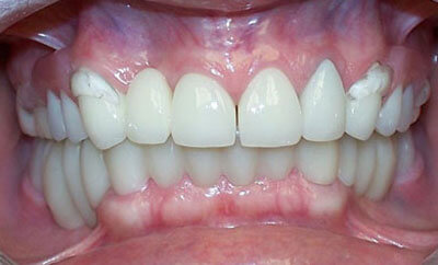 Maxillary-Fixed-with-Clear-Frame-Partial-&-Mand-Snap-On-Smile-after-1