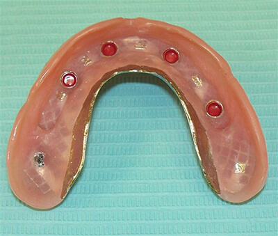 Maxillary Implant-Bar-Locator Supported Overdenture-after-1