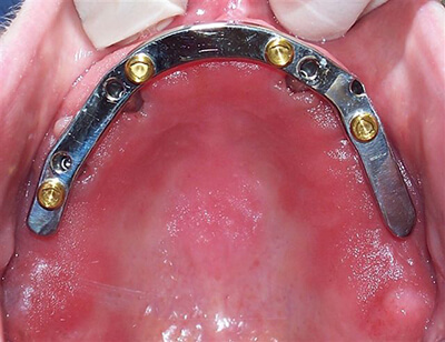 Maxillary Implant-Bar-Locator Supported Overdenture-before-1