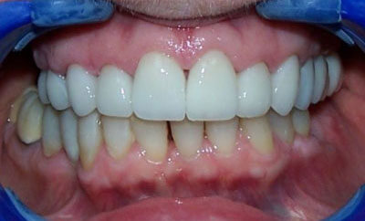Maxillary-Porcelain-Crowns-after-1