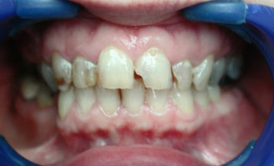 Maxillary-Porcelain-Crowns-before-1