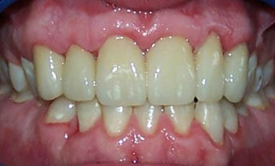 Severe-caries-Veneer-6-11-and-composite-rehabilitation-after-1