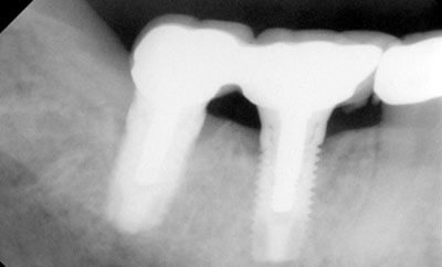 Splinted-Implant-Supported-Crowns-after-1