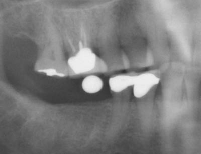 Splinted implant supported crowns-30-31-before-1