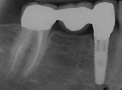 Tooth-Implant-Zirconia Abutment-Supported Bridge-after-1