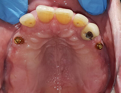 Two Implants with Locators supporting Upper Partial-1