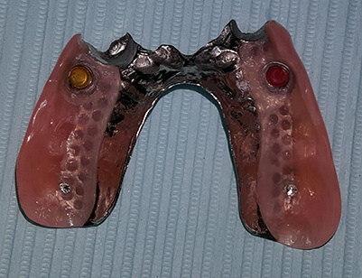 Two Implants with Locators supporting Upper Partial-3