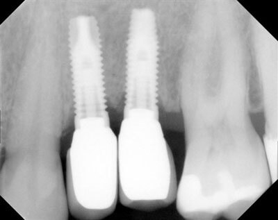 Zirconia Abutments and Crowns-4-12-13-left