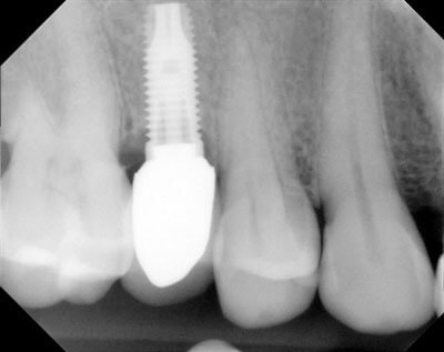Zirconia Abutments and Crowns-4-12-13-right
