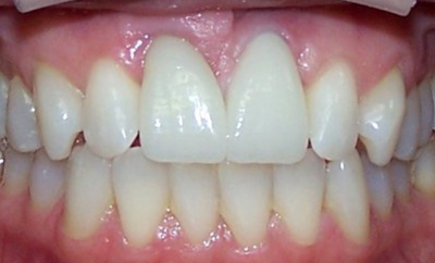 Implant-Supported-Crown-after